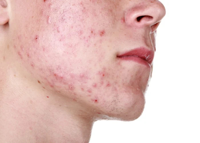 acne-scaled